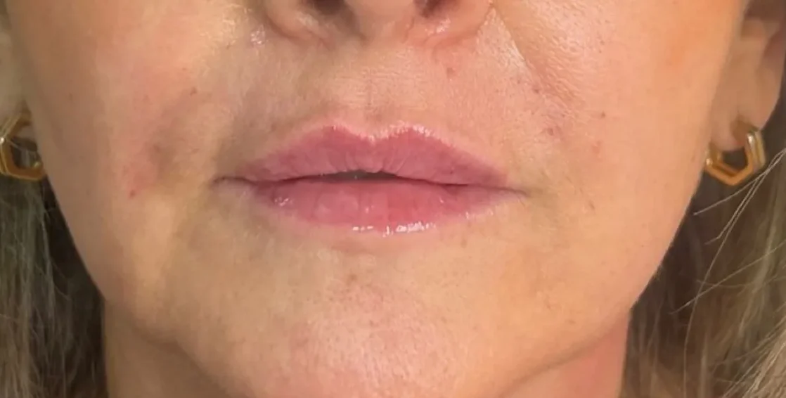 The same lips after lip enhancement at The Hill Clinic