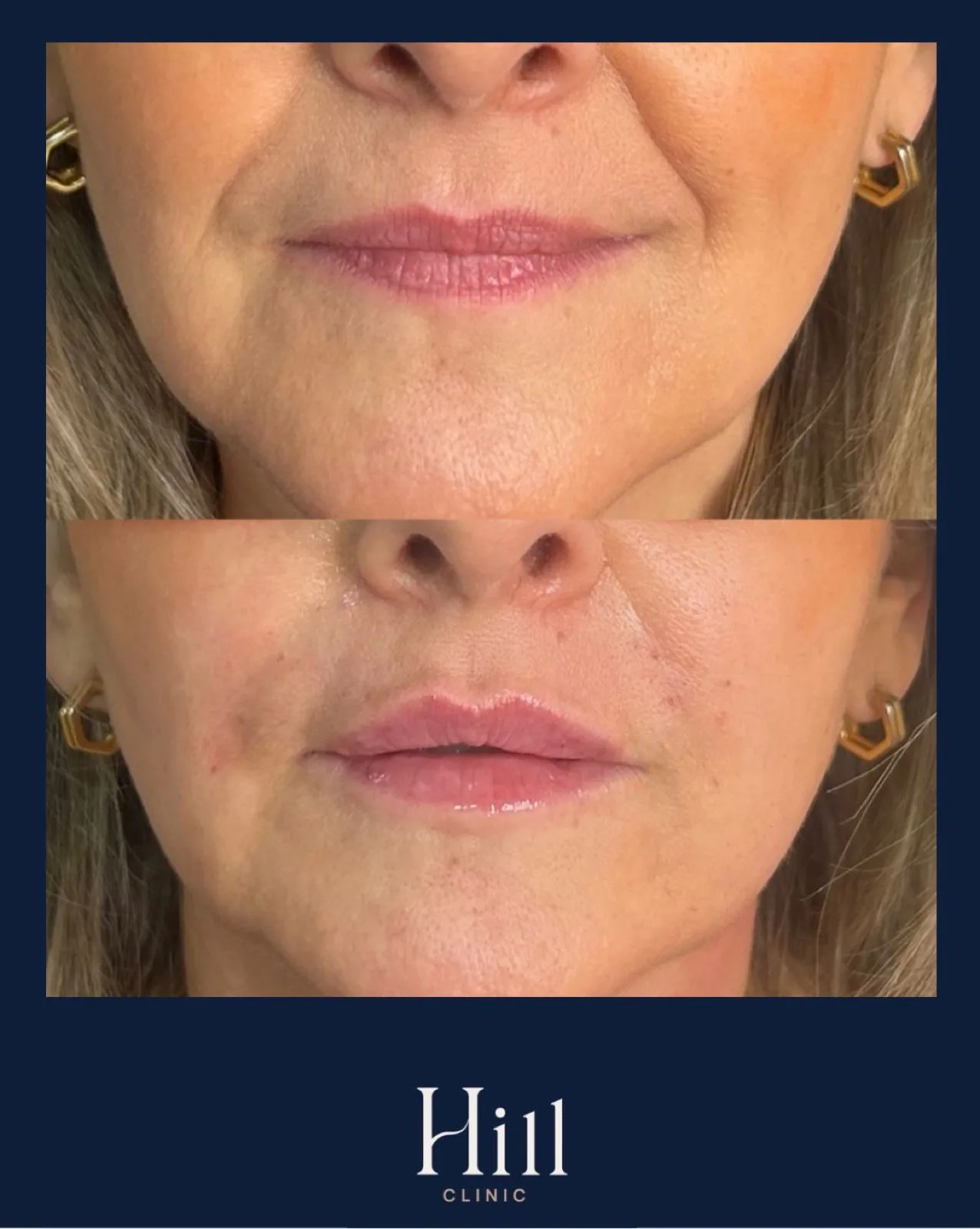 Lip enhancement, before and after