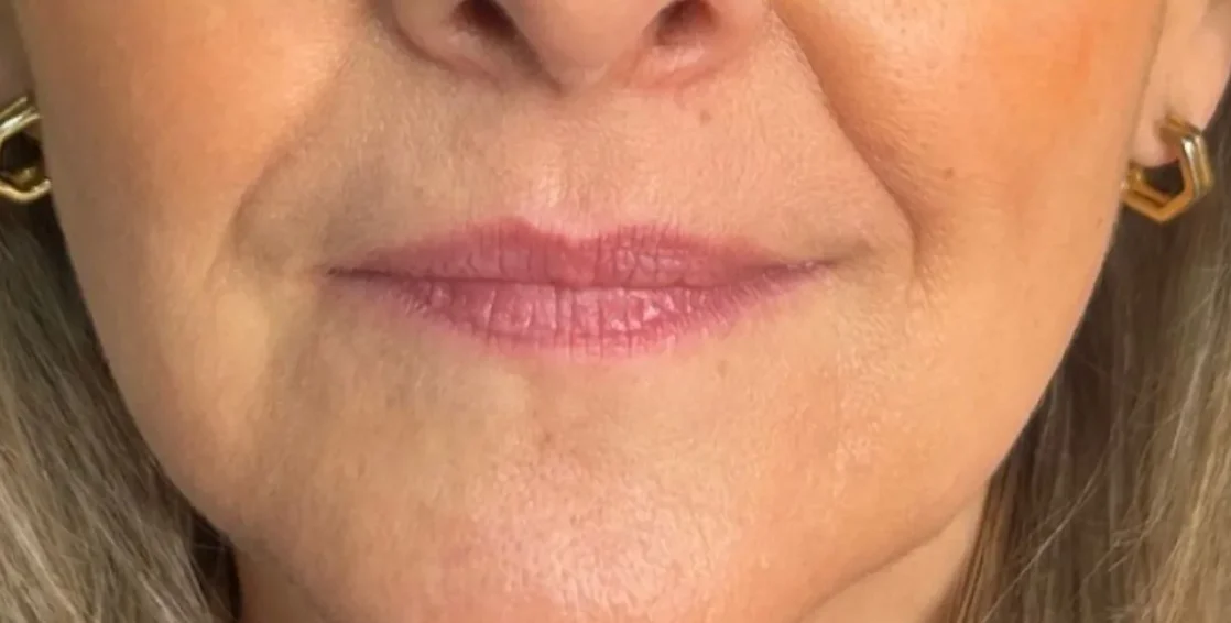 Lips before treatment at The Hill Clinic
