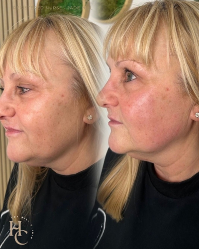 Bio Stimulating Filler