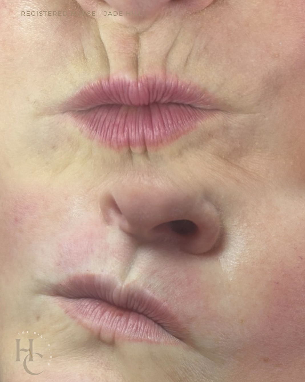 Peri Oral - Smokers lines