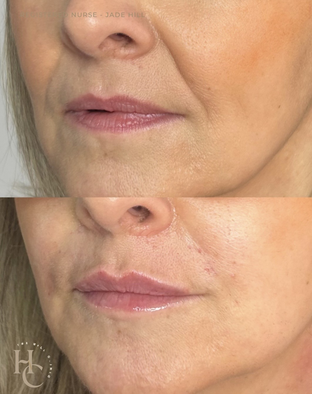 Lips and Nasolabial Refresh 